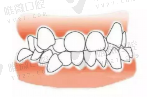 被诊所忽悠做了窝沟封闭？学校组织窝沟封闭靠谱吗，相关知识！(图1)